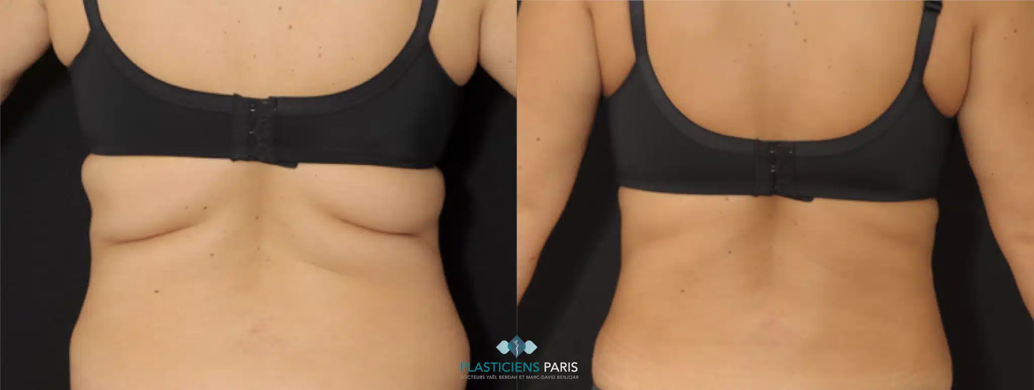 liposuccion liposuccion du dos et du bourrelet sous le soutien gorge
