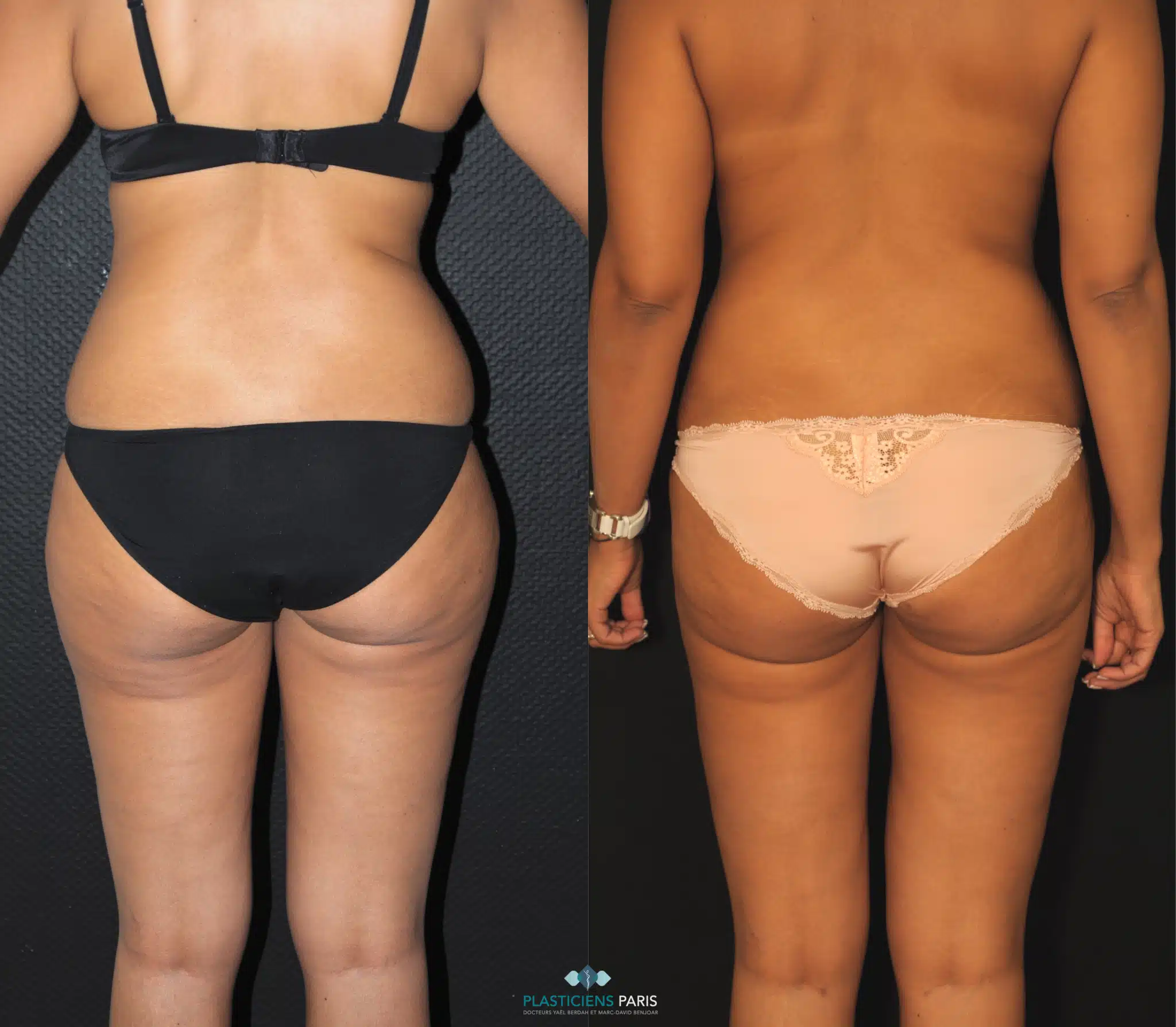 liposuccion hanches et cuisses