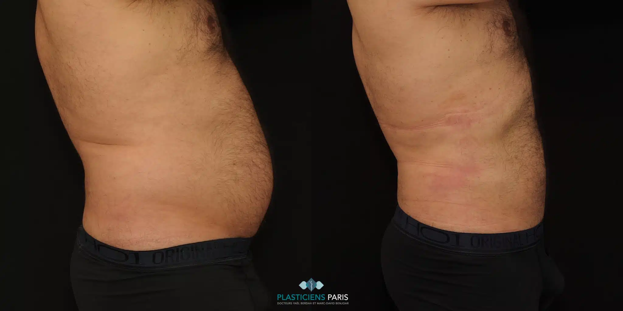 liposuccion liposuccion de l adomen chez l homme