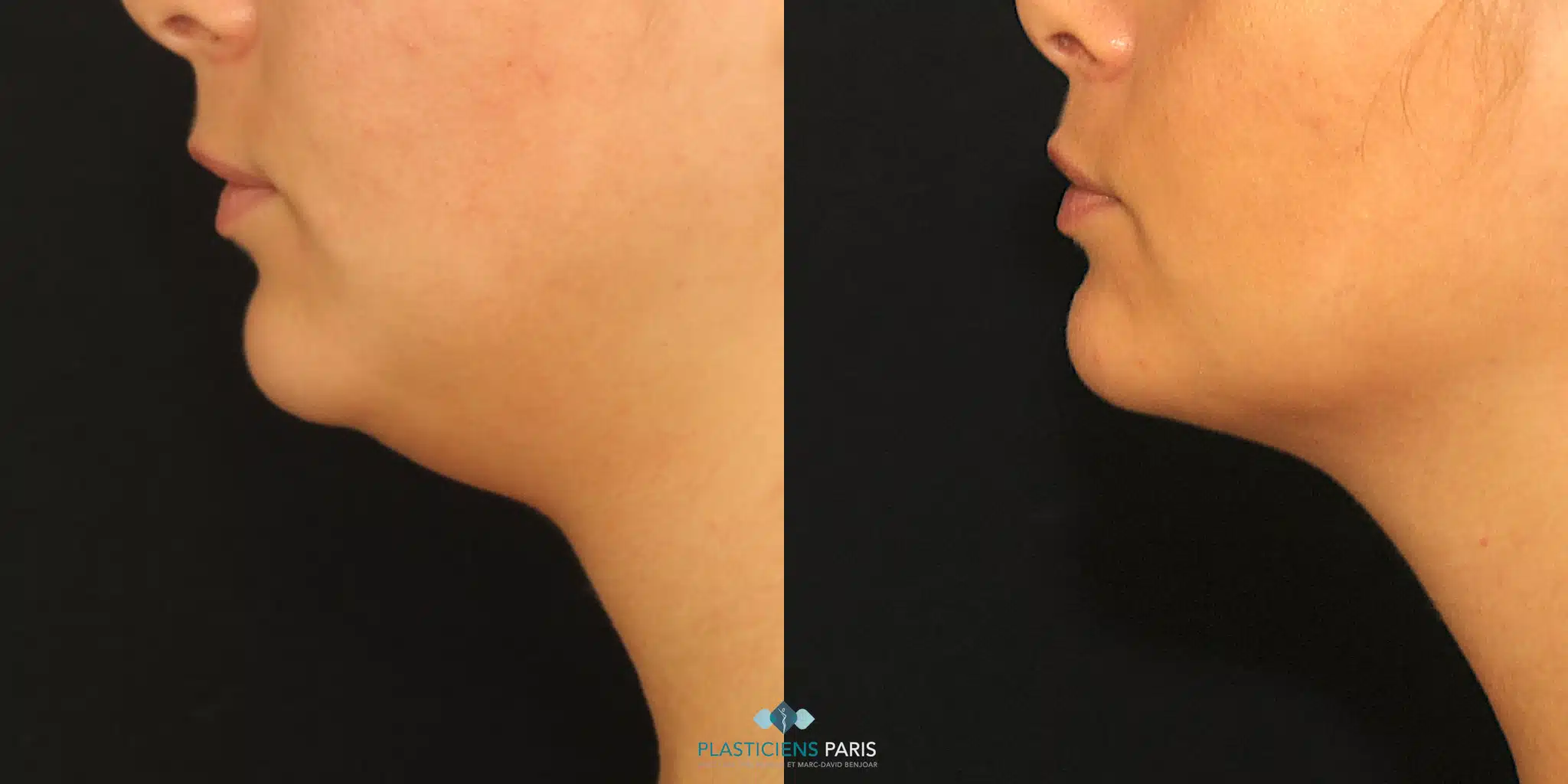 liposuccion mention vue de face