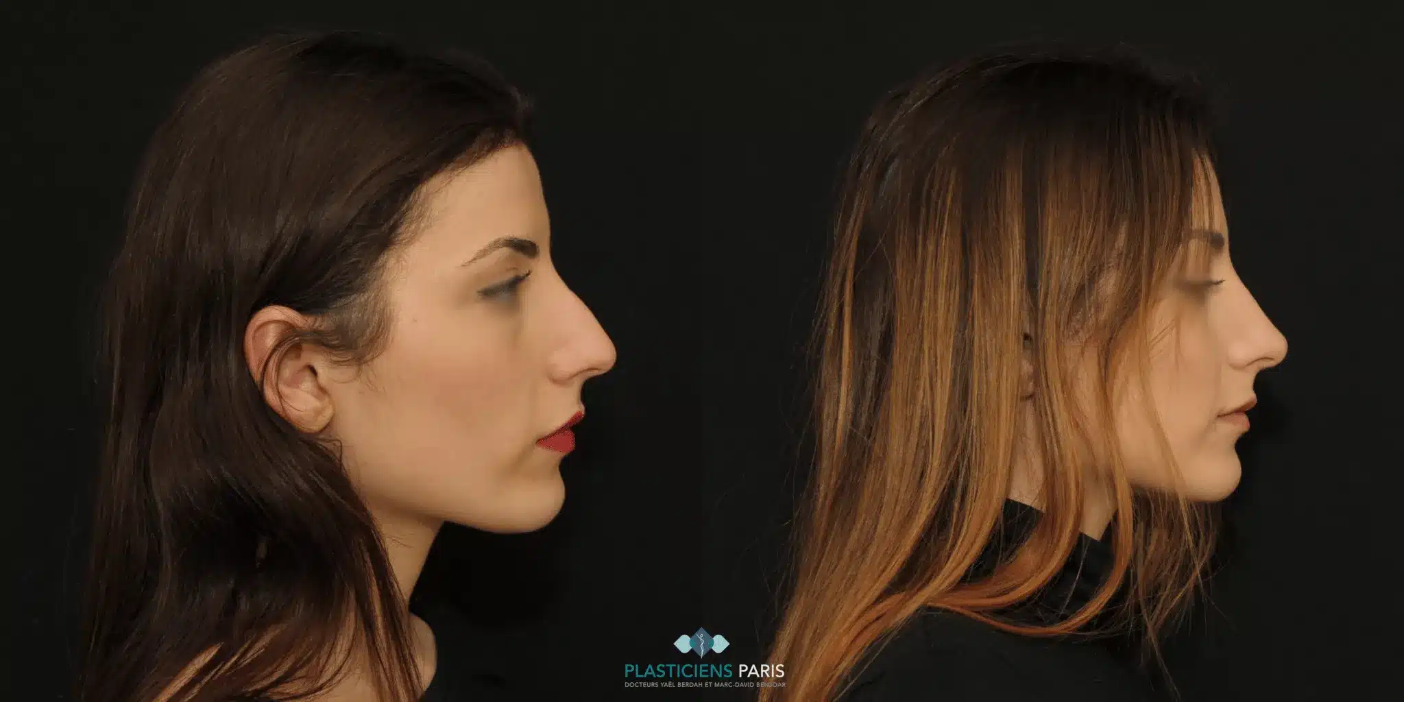 rhinoplastie