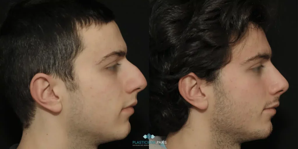 photos rhinoplastie avant après