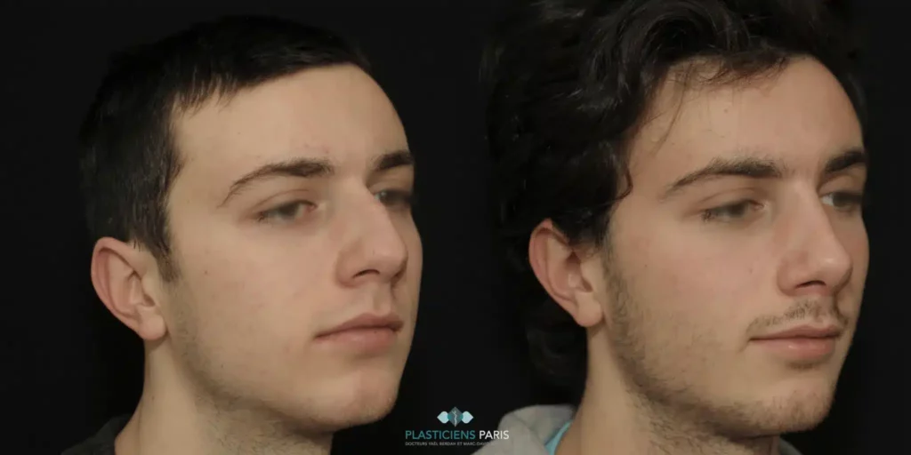 photos rhinoplastie avant après