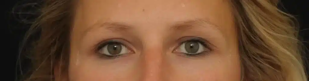 après Injection de botox