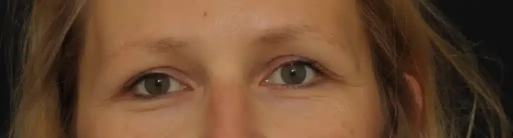 avant Injection de botox