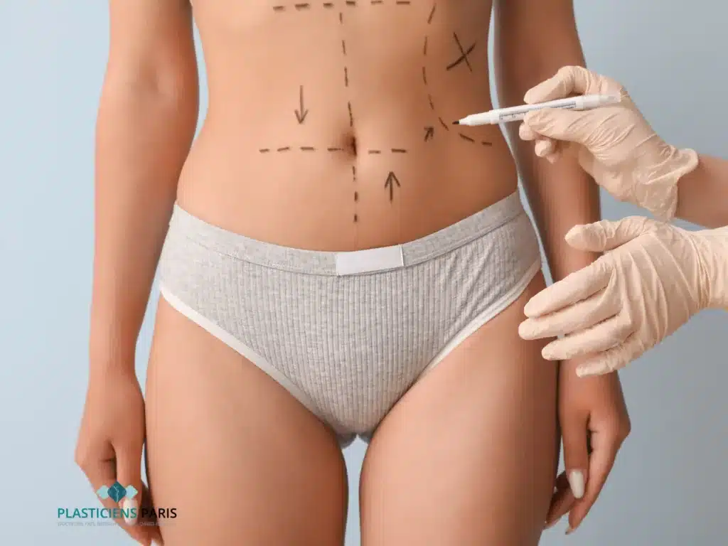 prise en charge abdominoplastie