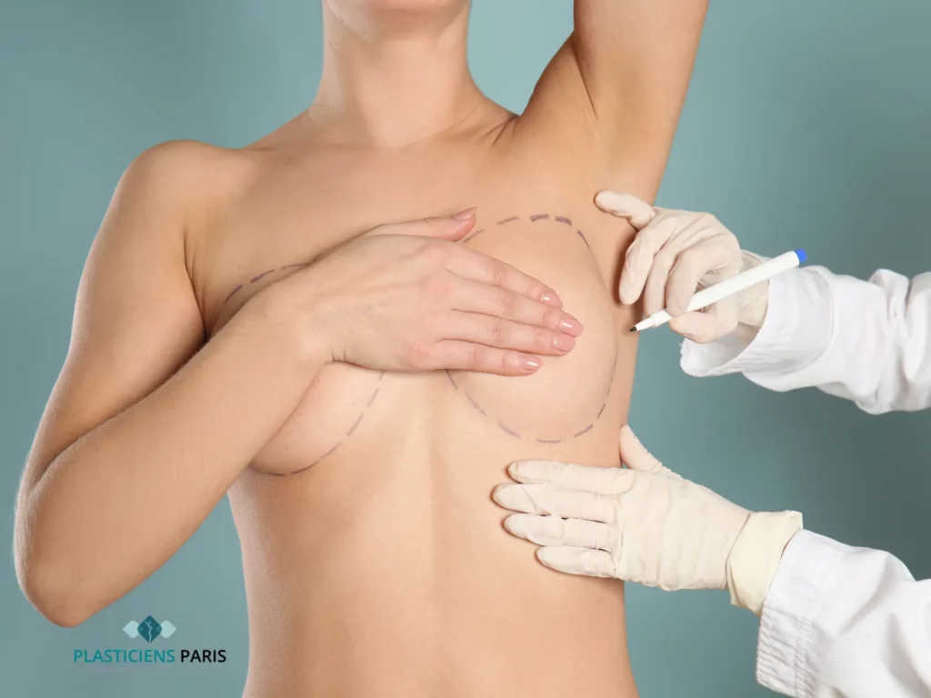 augmentation mammaire devant ou sous le muscle