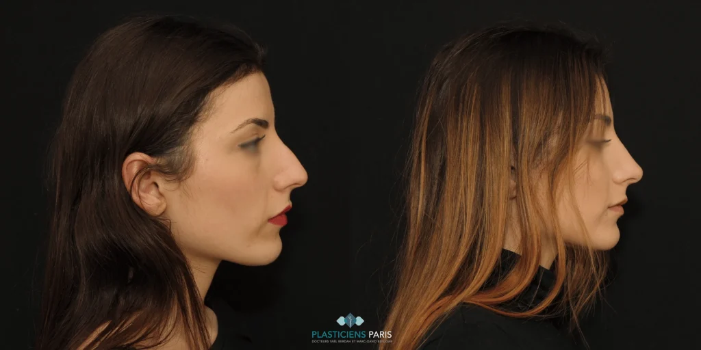 Rhinoplastie pour enlever une bosse sur le nez