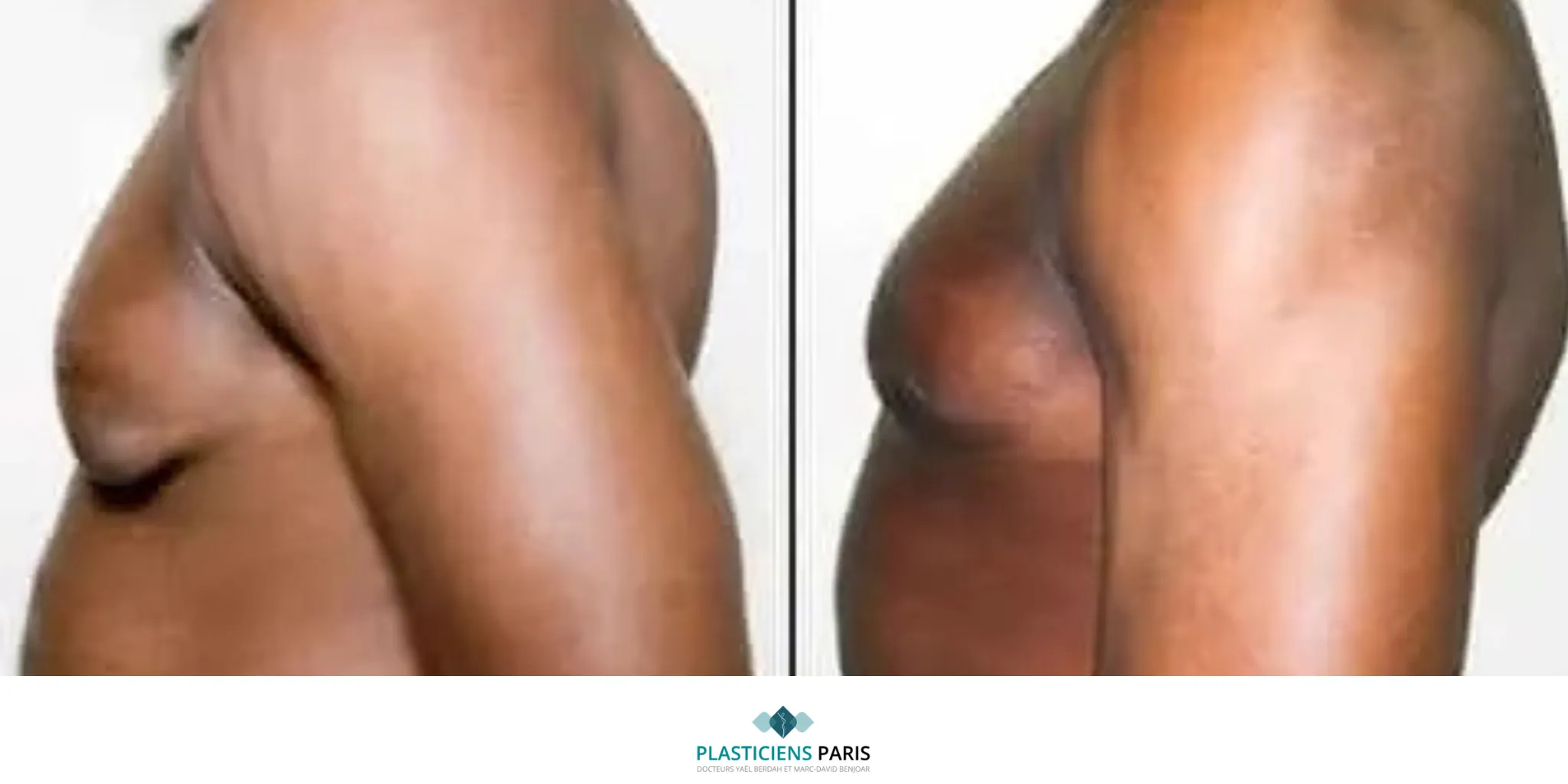 chirurgie gynécomastie avant après
