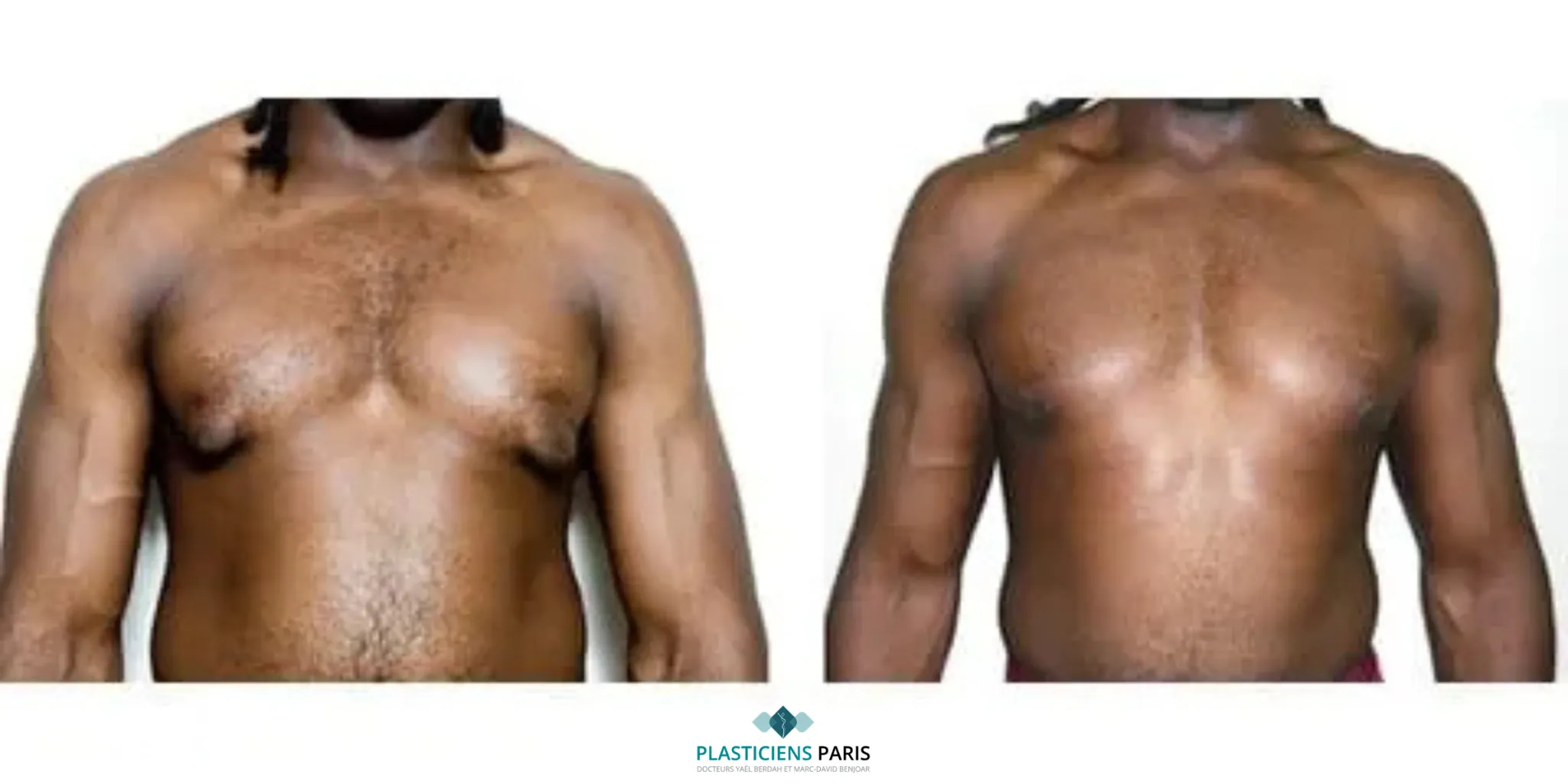 gynecomastie hernie areolaire avant après